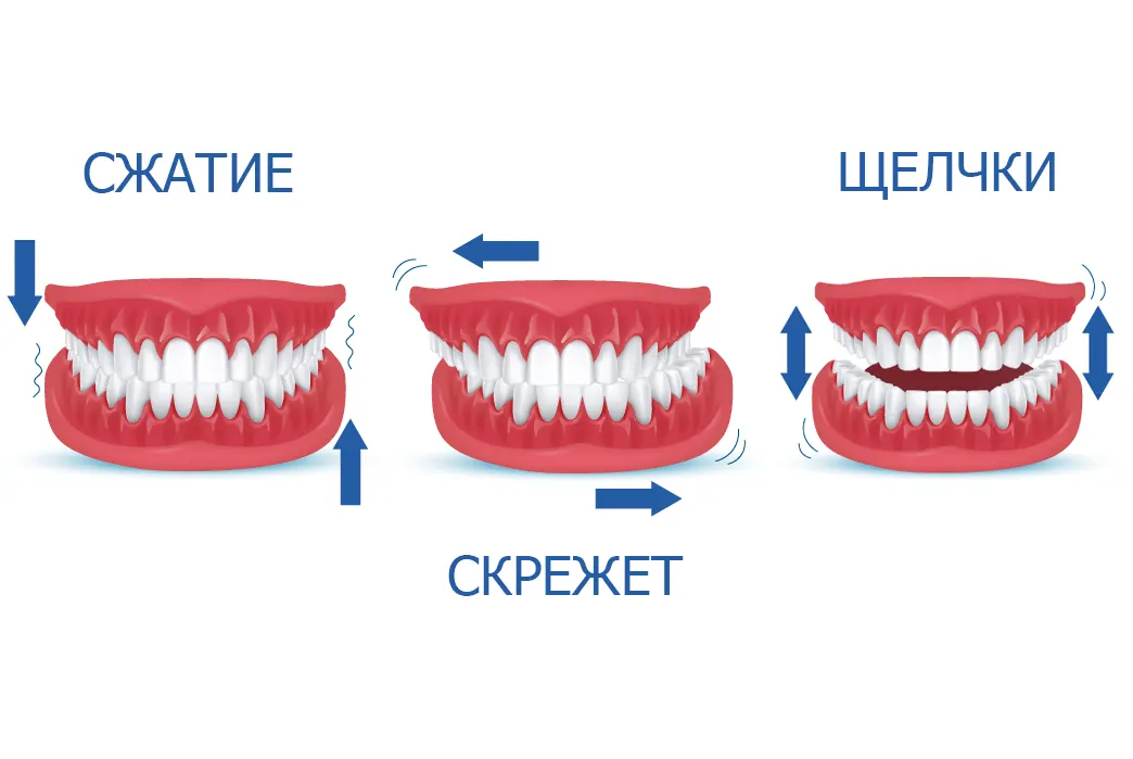 Внешние проявления бруксизма