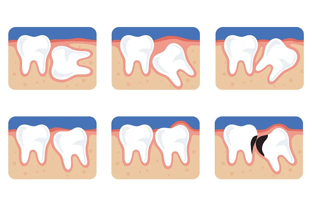 Ретинированные и дистопированные зубы