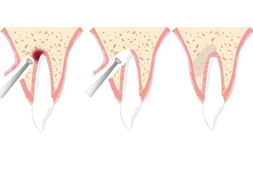 Как проводится удаление верхушки корня зуба при воспалении: схема